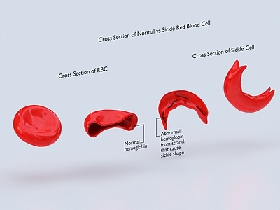 现代红血球 镰刀型红血球