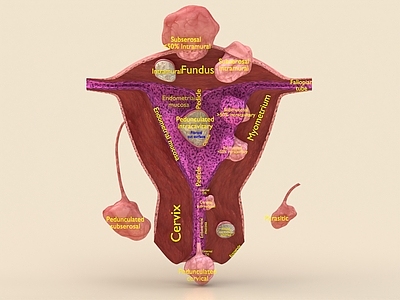医疗器材 子宫肌瘤 子宫癌 肿瘤 解刨 解剖 医学 生物学